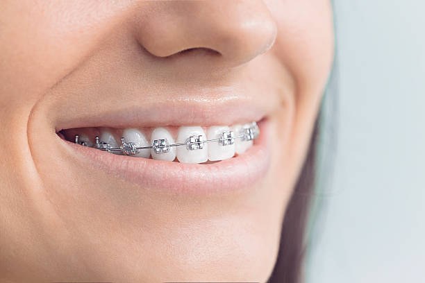 Best Dental Bonding  in Orange, OH